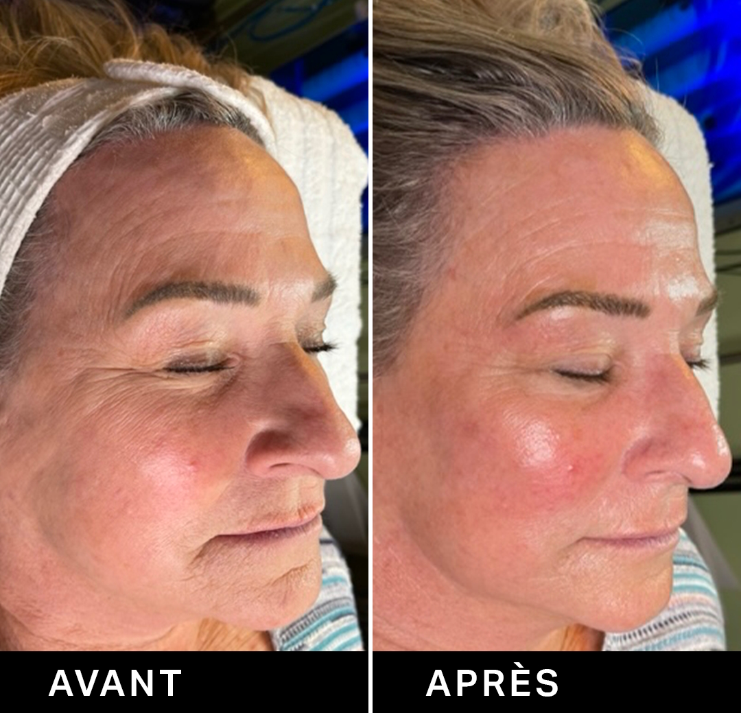 Résultats Hydrafacial